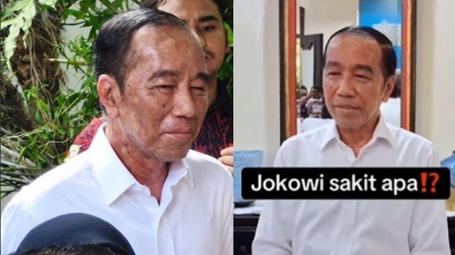 Dokter Richard Lee Duga Jokowi Alami Alergi Obat hingga Autoimun, Sarankan Segera Cek Lab