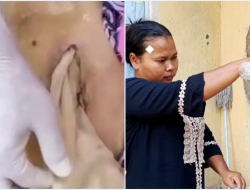 KASUS MALAPRAKTEK: Lansia di Bekasi Tewas Usai Operasi, Kasa Tertinggal di Perut Tanpa Dijahit, RS Klaim SOP
