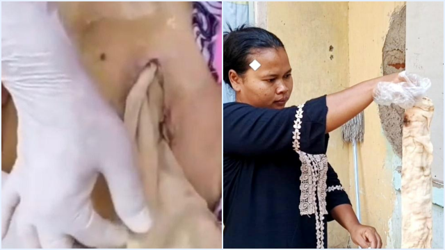 KASUS MALAPRAKTEK: Lansia di Bekasi Tewas Usai Operasi, Kasa Tertinggal di Perut Tanpa Dijahit, RS Klaim SOP