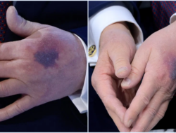 Memar di Tangan Donald Trump di Davos: Penyebab, Penjelasan Medis, dan Dampak Aspirin