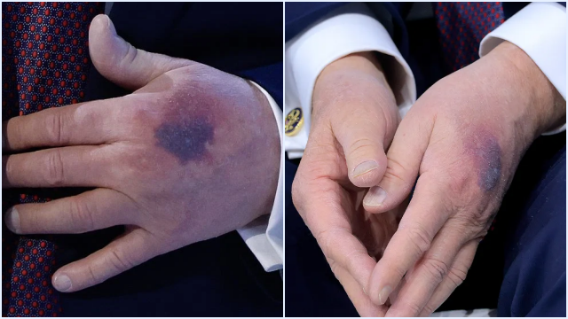 Memar di Tangan Donald Trump di Davos: Penyebab, Penjelasan Medis, dan Dampak Aspirin