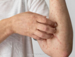 Dinkes Sultra Waspadai Potensi Lonjakan Campak Usai Lebaran