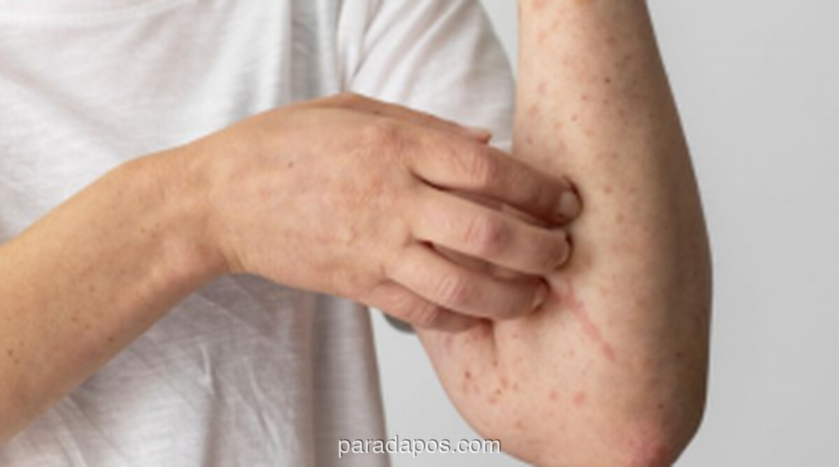 Dinkes Sultra Waspadai Potensi Lonjakan Campak Usai Lebaran