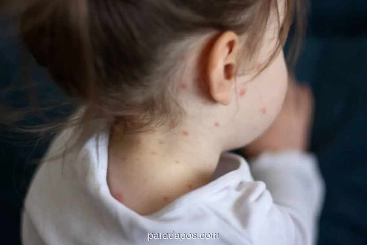 IDAI Serukan Kejar Imunisasi Campak, Indonesia Peringkat Kedua Kasus Tertinggi Dunia