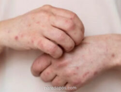 Kemenkes Perketat Kewaspadaan Campak di Fasyankes, Tenaga Medis Jadi Kelompok Rentan