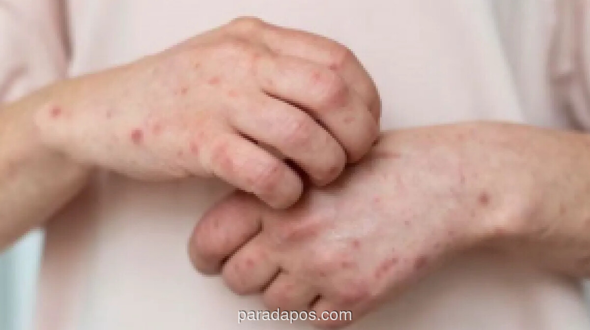 Kemenkes Perketat Kewaspadaan Campak di Fasyankes, Tenaga Medis Jadi Kelompok Rentan