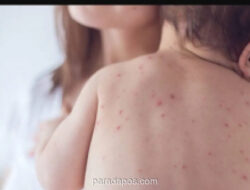 Dinkes DKI Imbau Waspada Penularan Campak Saat Silaturahmi Idulfitri