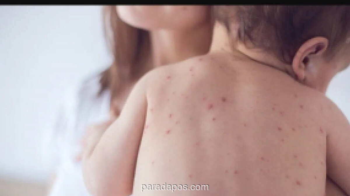 Dinkes DKI Imbau Waspada Penularan Campak Saat Silaturahmi Idulfitri