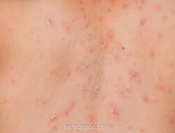 DKI Jakarta Gelar Imunisasi Kejar Campak Serentak Sepanjang Maret 2026