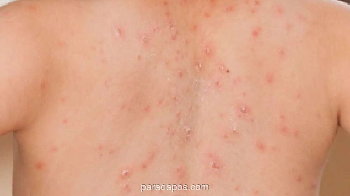 DKI Jakarta Gelar Imunisasi Kejar Campak Serentak Sepanjang Maret 2026